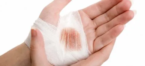 {'en': 'Diabetes can hinder scar (study)', 'es': 'La diabetes puede dificultar la cicatrización (Estudio)'} Image {'en': 'Diabetes can hinder scar (study)', 'es': 'La diabetes puede dificultar la cicatrización (Estudio)'} Image