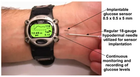 {'en': 'A microchip to control glucose: Glucowizzard', 'es': 'Un microchip para controlar la glucosa: glucowizzard'} Image {'en': 'A microchip to control glucose: Glucowizzard', 'es': 'Un microchip para controlar la glucosa: glucowizzard'} Image