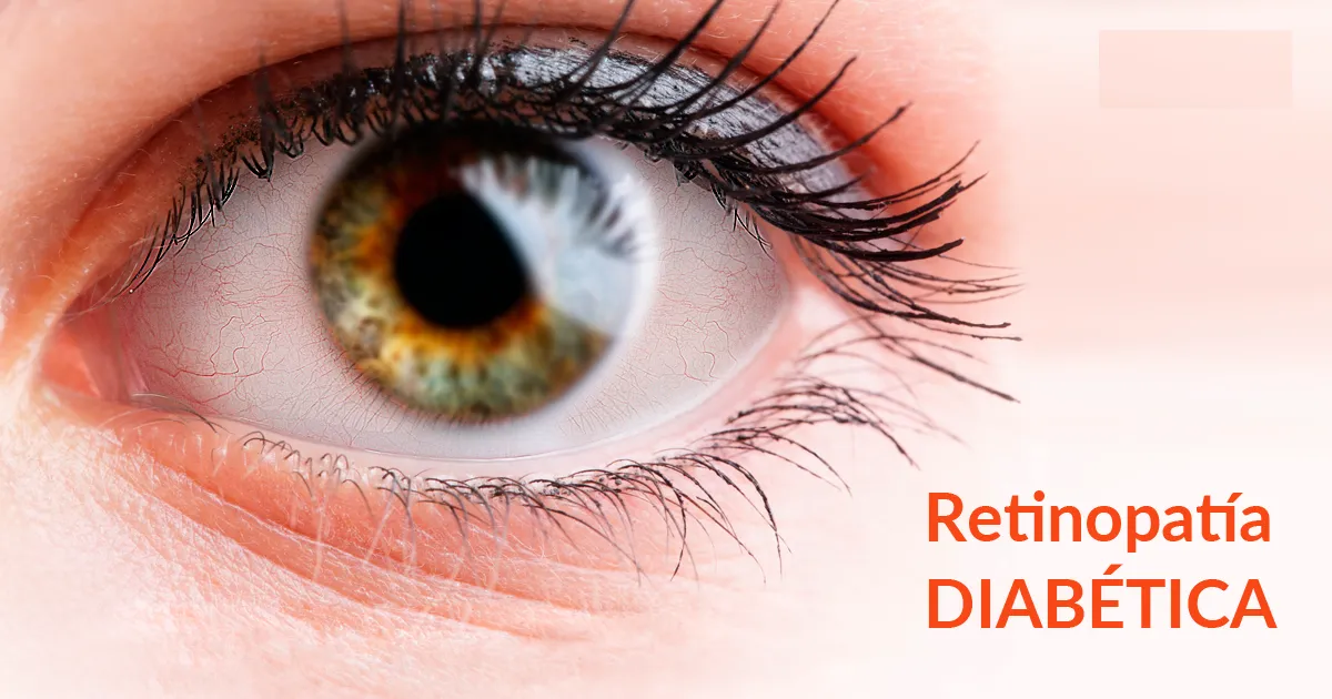 {'en': 'Eye inflammation, the early sign that we should not ignore to prevent retinopathy', 'es': 'La inflamación ocular, la señal temprana que no deberíamos ignorar para prevenir la retinopatía'} Image