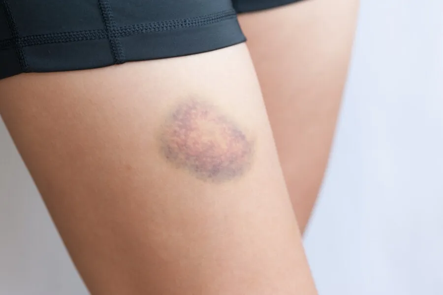 {'en': 'Bruces for punctures', 'es': 'Crema para hematomas por pinchazos'} Image {'en': 'Bruces for punctures', 'es': 'Crema para hematomas por pinchazos'} Image