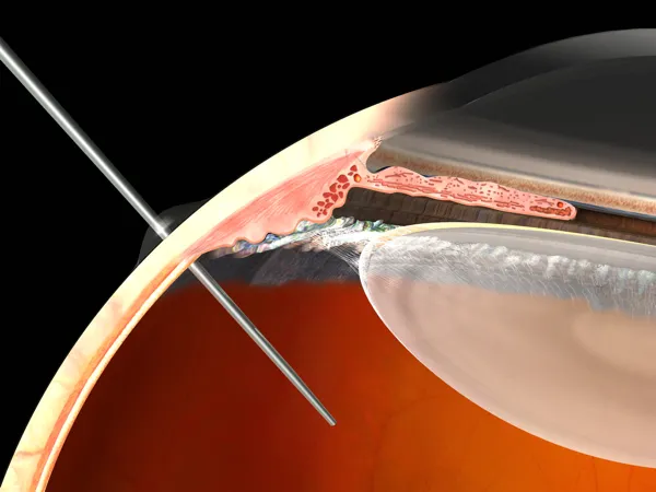 {'en': 'Have anyone put intravitrea injection?', 'es': '¿A alguien le han puesto la Inyección Intravitrea?'} Image {'en': 'Have anyone put intravitrea injection?', 'es': '¿A alguien le han puesto la Inyección Intravitrea?'} Image