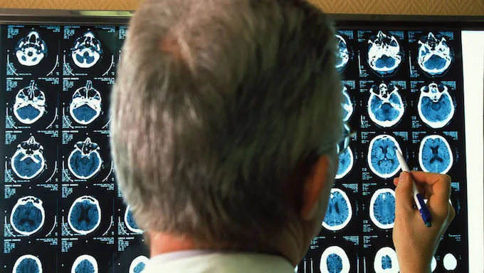 {'en': "Drug for diabetes that improves memory and Alzheimer's", 'es': 'Fármaco para la diabetes que mejora la memoria y el alzhéimer'} Image {'en': "Drug for diabetes that improves memory and Alzheimer's", 'es': 'Fármaco para la diabetes que mejora la memoria y el alzhéimer'} Image