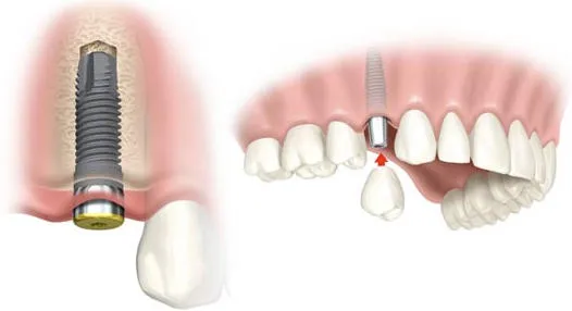 {'en': 'Diabetes and dental implants', 'es': 'Diabetes y los implantes dentales'} Image {'en': 'Diabetes and dental implants', 'es': 'Diabetes y los implantes dentales'} Image