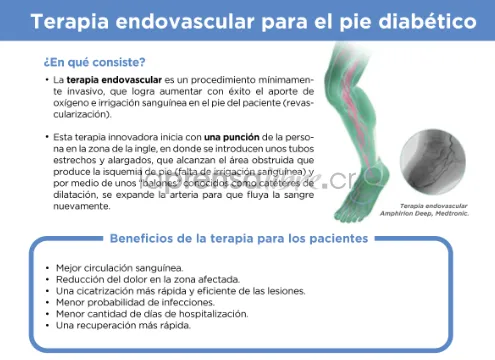 {'en': 'Therapy prevents 90% amputations by diabetic foot', 'es': 'Terapia previene 90% de amputaciones por pie diabético'} Image {'en': 'Therapy prevents 90% amputations by diabetic foot', 'es': 'Terapia previene 90% de amputaciones por pie diabético'} Image