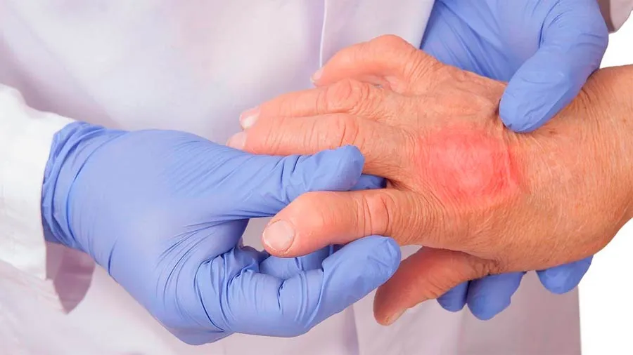 {'en': 'If you have psoriatic arthritis, you could suffer diabetes', 'es': 'Si tienes artritis psoriásica, podrías padecer diabetes'} Image {'en': 'If you have psoriatic arthritis, you could suffer diabetes', 'es': 'Si tienes artritis psoriásica, podrías padecer diabetes'} Image