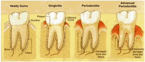 {'en': 'Periodontitis could be an early sign of non -diagnosed diabetes', 'es': 'La periodontitis podría ser un signo precoz de una diabetes no diagnosticada'} Image {'en': 'Periodontitis could be an early sign of non -diagnosed diabetes', 'es': 'La periodontitis podría ser un signo precoz de una diabetes no diagnosticada'} Image